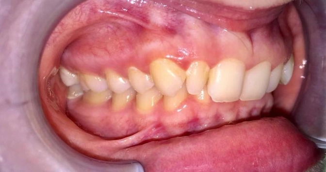 Виды прикуса. Глубокий прикус.