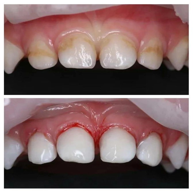 Лечение большого объема в условиях наркоза 