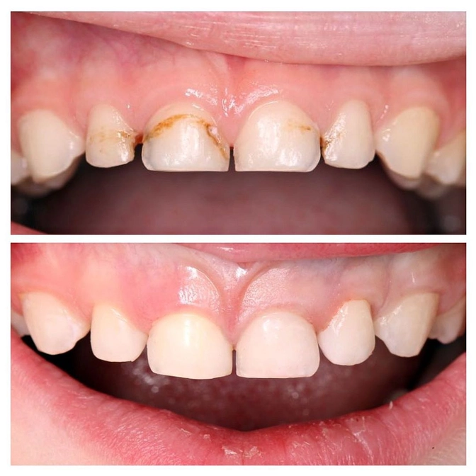 Стабилизация кариеса у ребёнка.