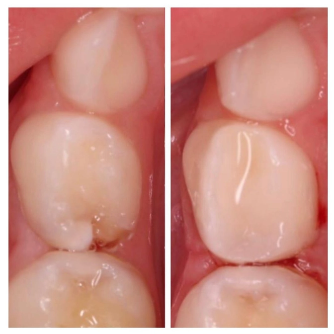 Как выглядит пульпит на "контакте" зубов?