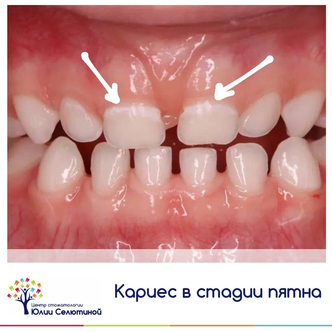 Кариес в стадии пятна 