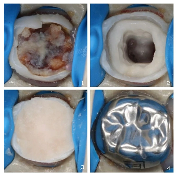 Лечение молочных зубов с покрытием коронкой 