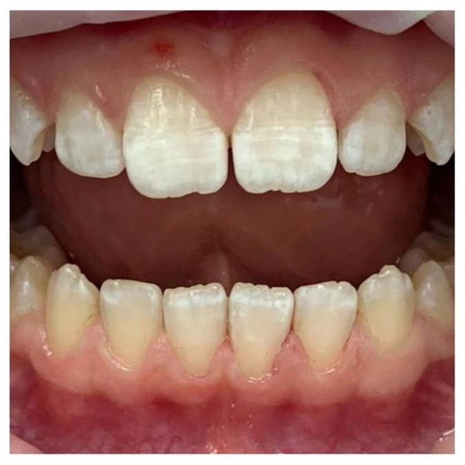 От чего возникает флюороз и как он выглядит?