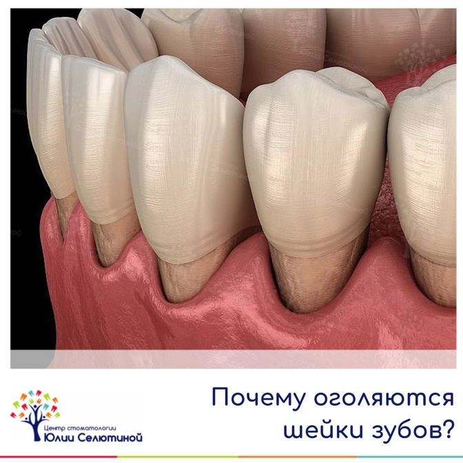 Почему оголяются шейки зубов? 