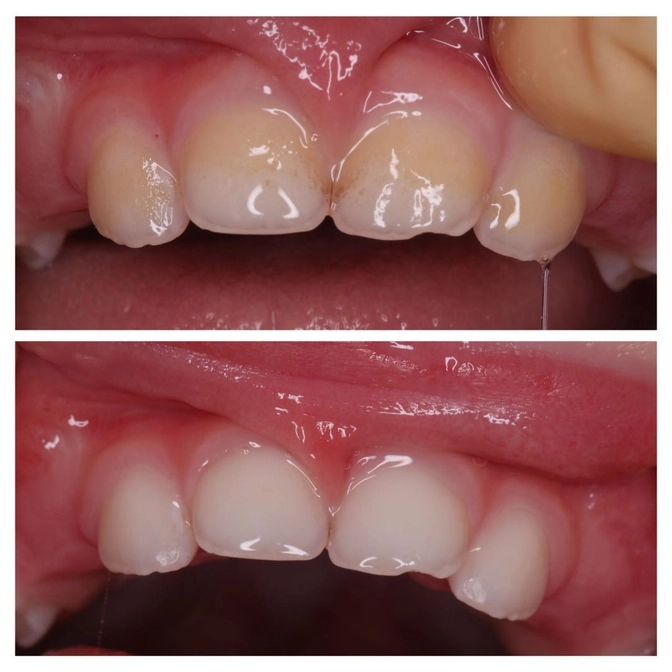 Тёмный налёт у ребёнка: что это? 