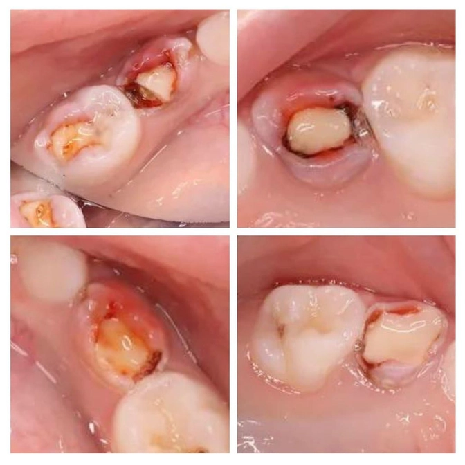 "Розовые зубы"