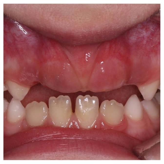 Постоянные зубы не прорезываются - что делать?