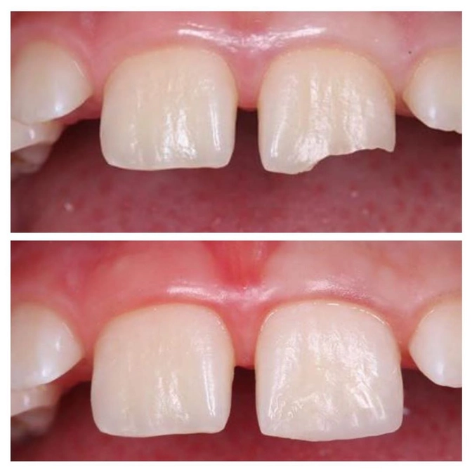 Травма постоянного зуба.