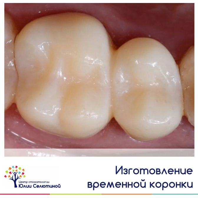 Изготовление временной коронки 