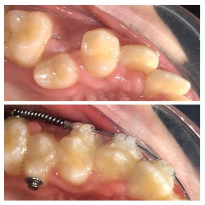 Создаем место для клыка