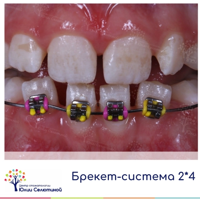 Частичная брекет-система у детей 