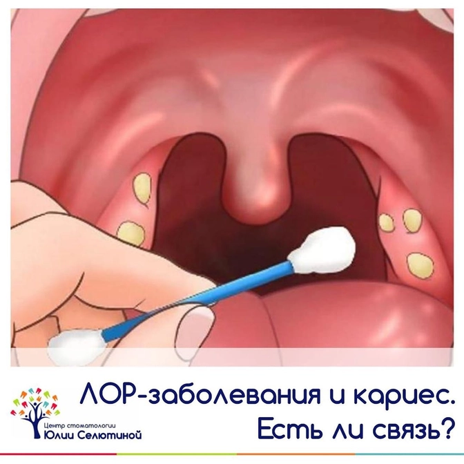 ЛОР-заболевания и кариес: есть ли связь? 
