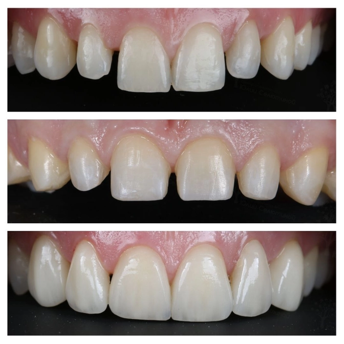 Зубы под винирами портятся!