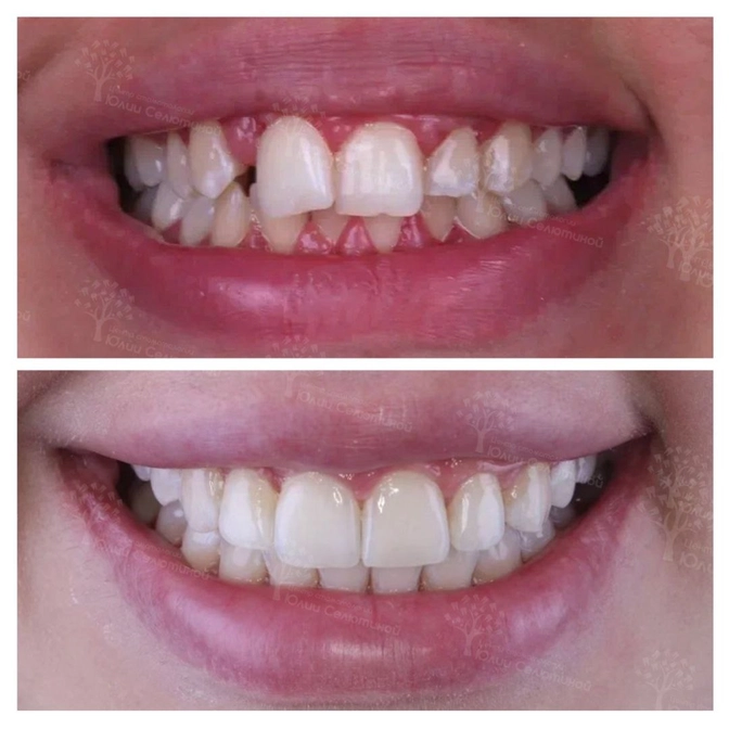 Клинический случай: выводим боковой резец из тени. 