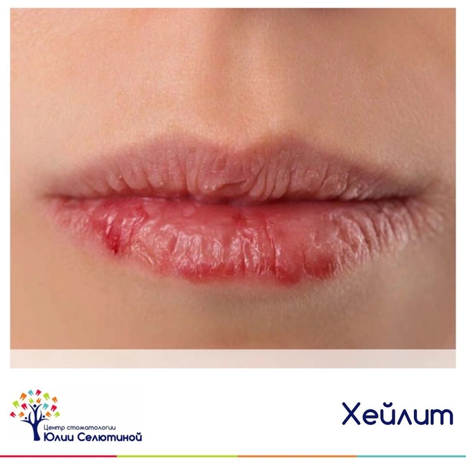 Хейлиты: проявления и лечение. 