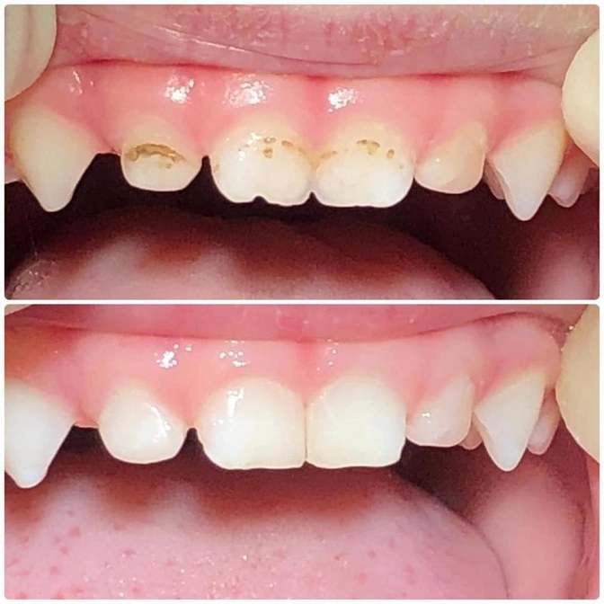 Реставрация центральных молочных зубов.