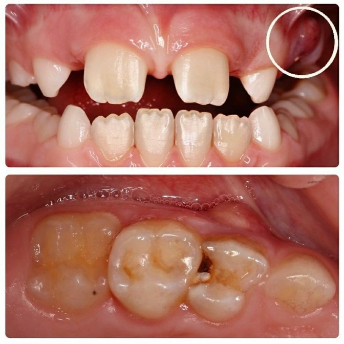 Удаление молочного зуба из-за свища 