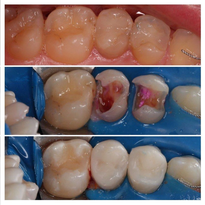 Зачем менять старые пломбы 