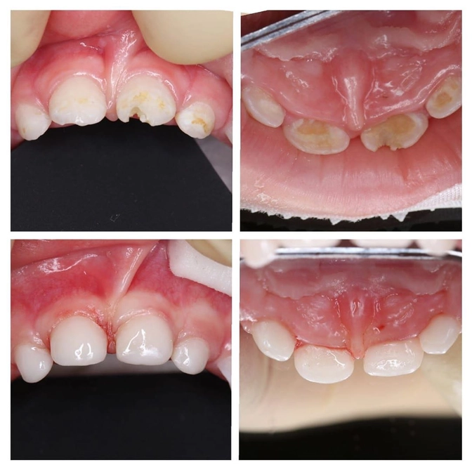 Лечение кариеса молочных зубов под наркозом