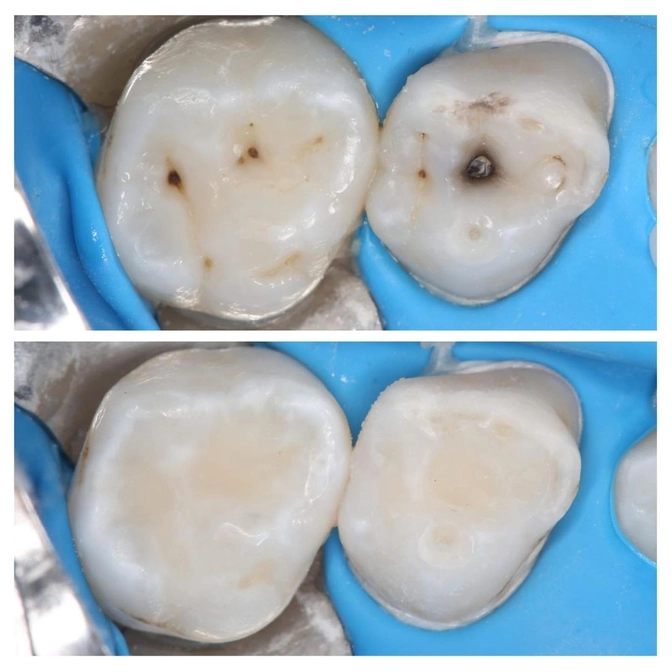 Что делать с "серебренными" зубами? 