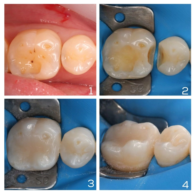 Лечение кариеса постоянных зубов под микроскопом