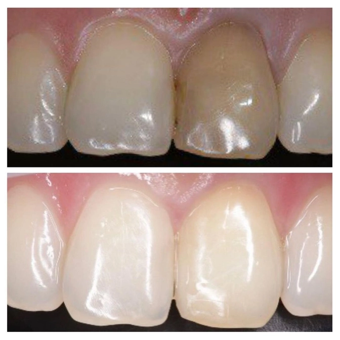 Что делать, если зуб потемнел? 