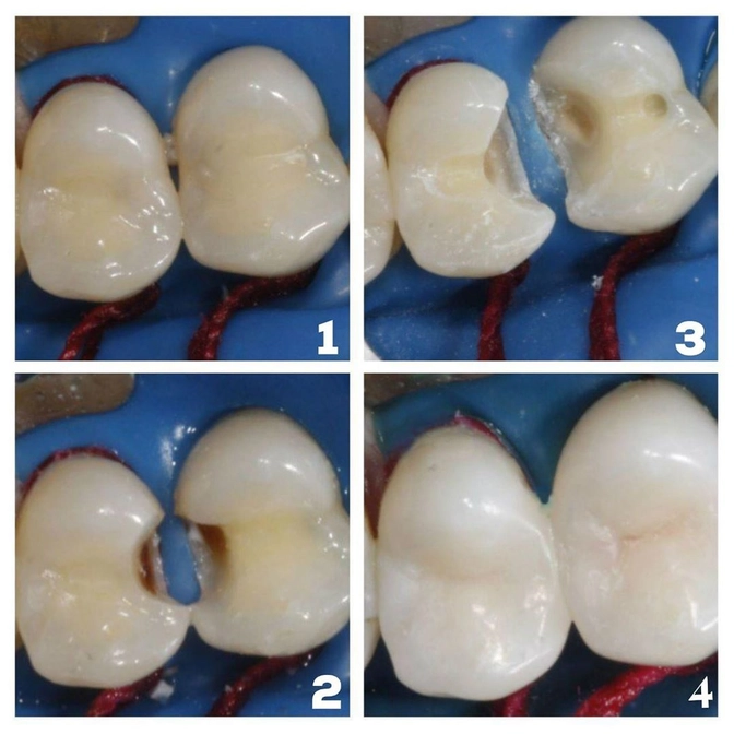 Как прячется кариес 