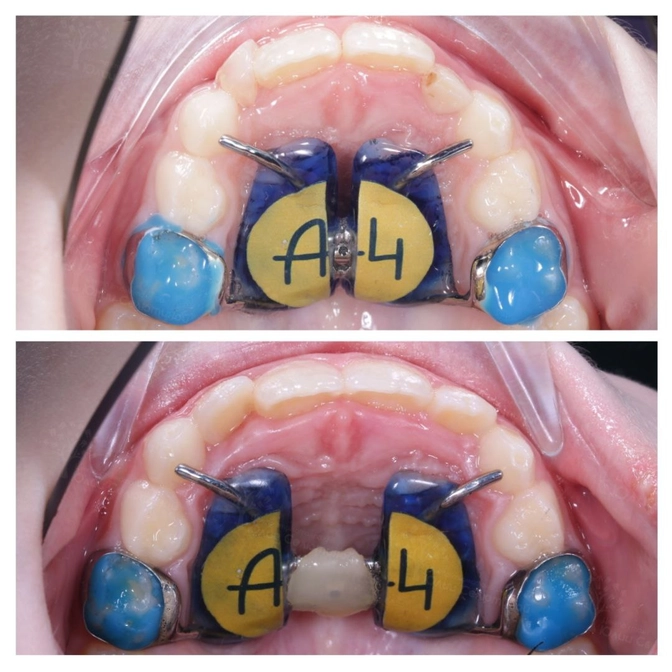 Как расширить челюсть, если она слишком узкая?