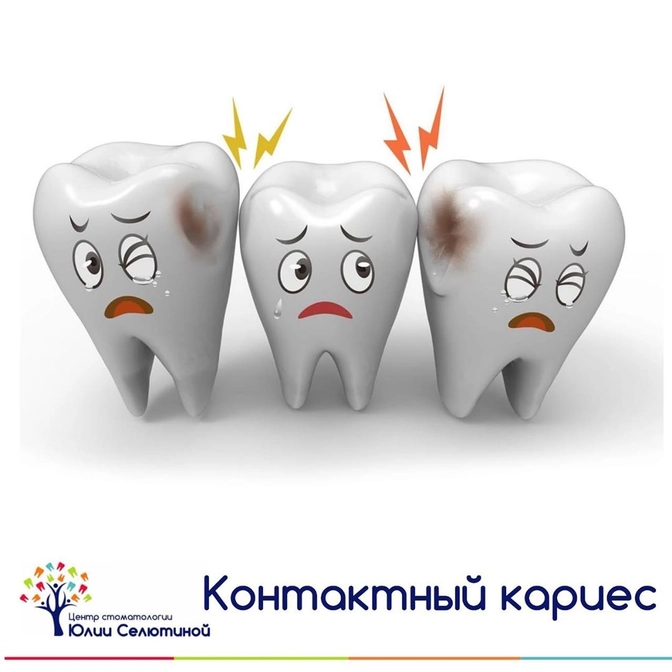 Контактный кариес: чем он опасен? 