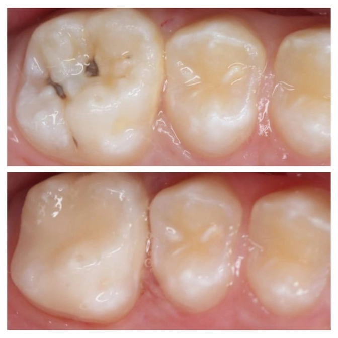 Лечение постоянного зуба у ребенка