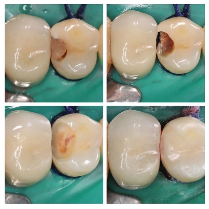 Лечение вторичного кариеса 