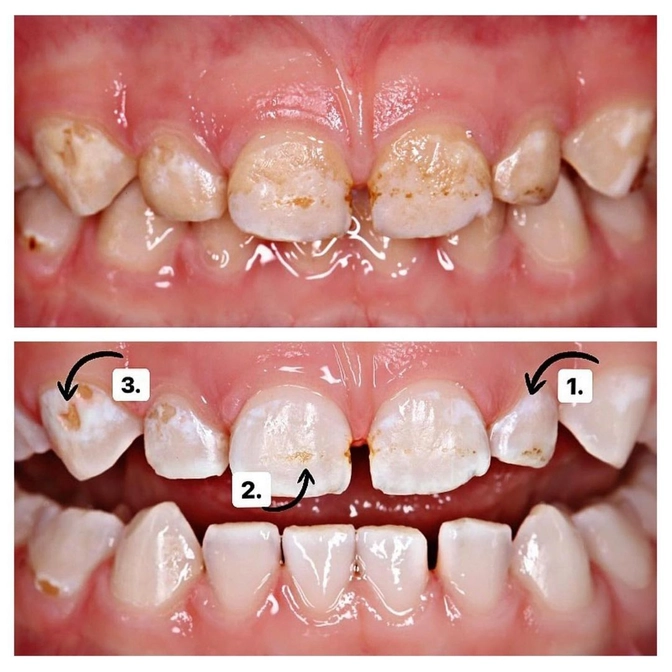 Что делать с налетом на зубах после антибиотиков? 