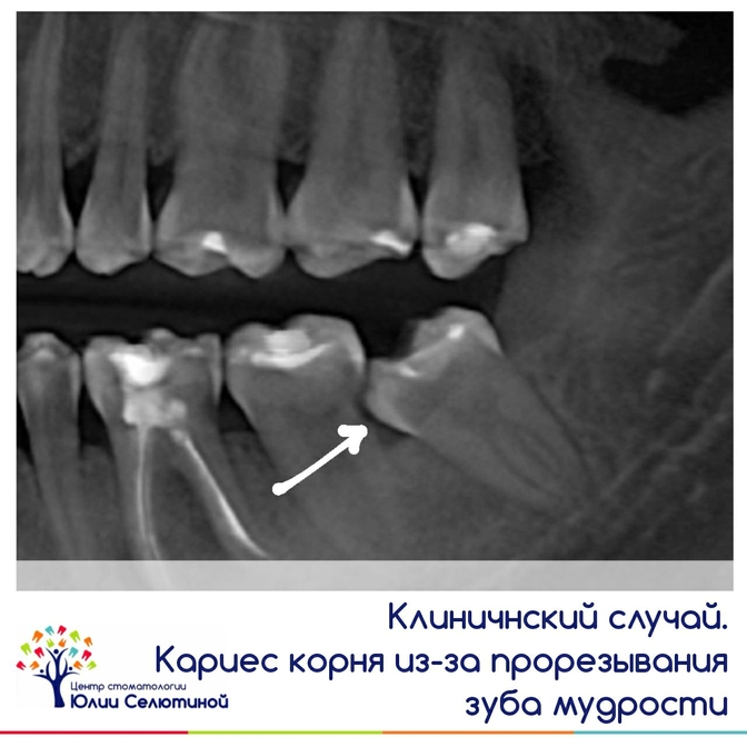 Клинический случай: кариес корня из-за прорезывания зуба мудрости. 