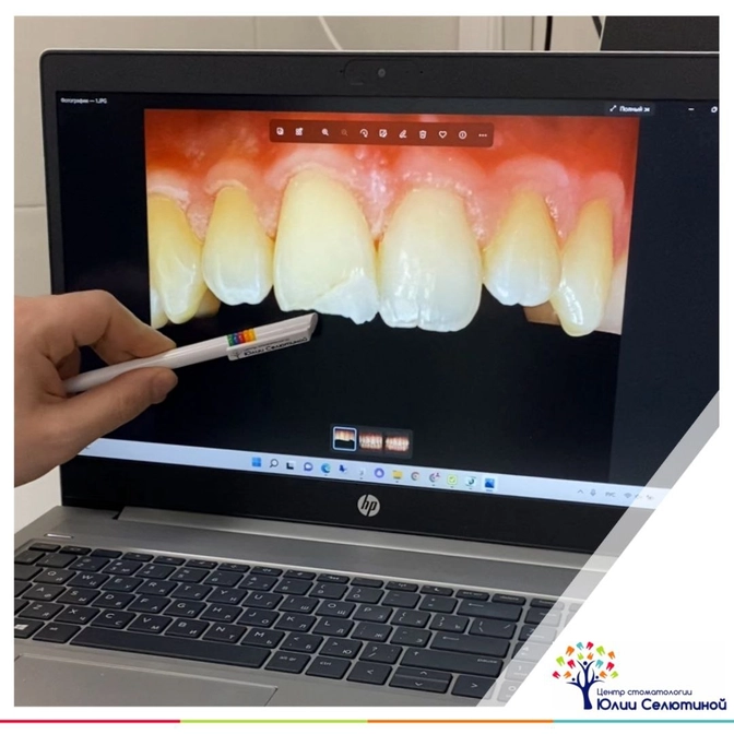 Замена композитных реставраций на керамические виниры