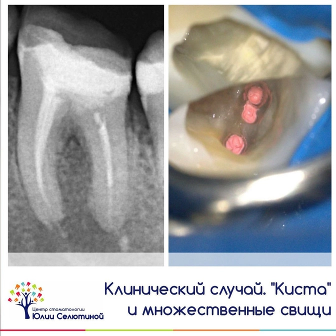 Клинический случай: лечение "кисты" зуба со свищами 
