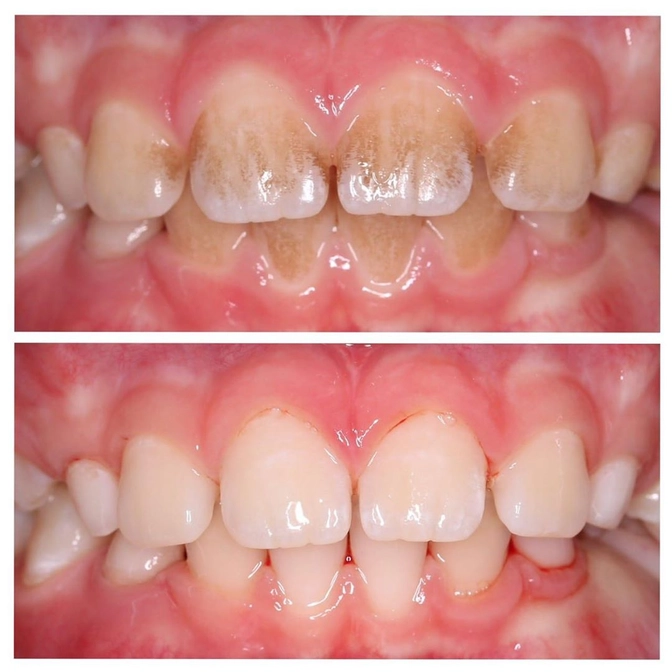 Чистка зубов и рекомендации 