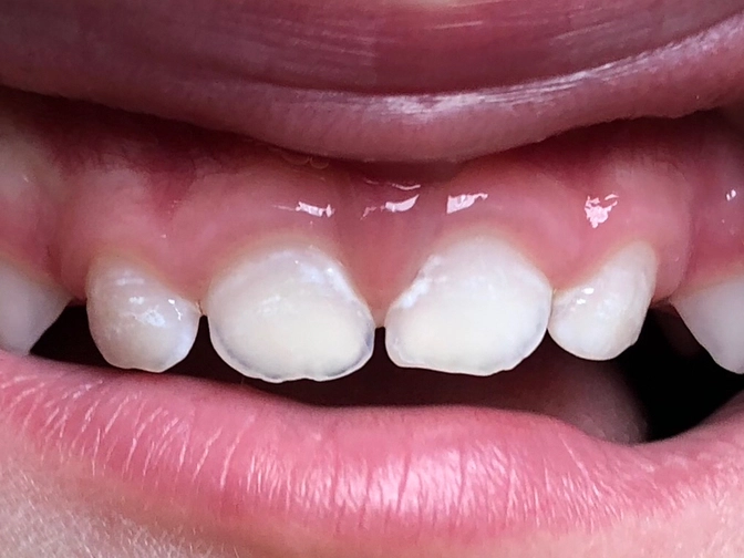 Клинический случай: кариес в стадии пятна.