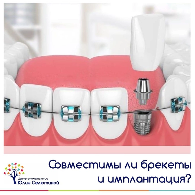 Совместимы ли брекет-лечение и имплантация?
