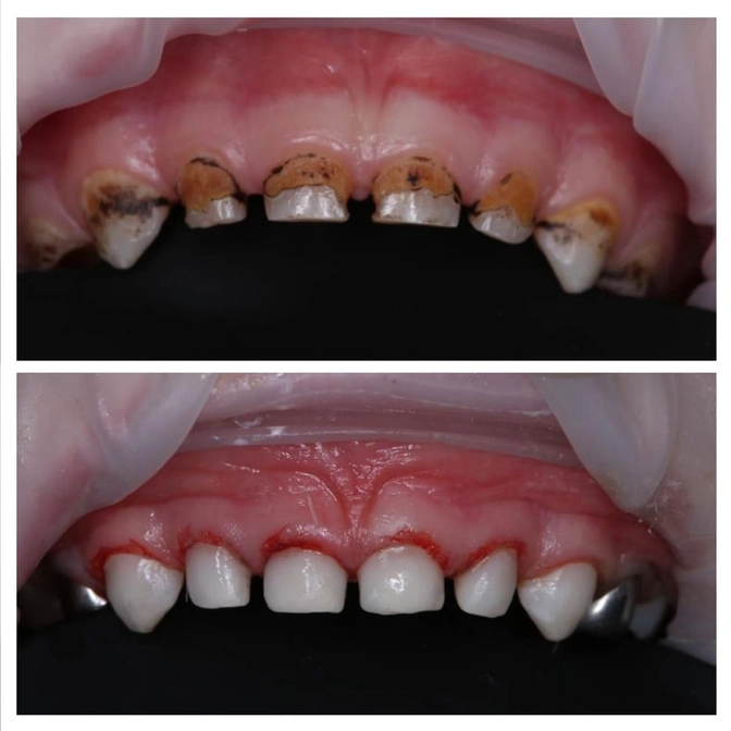 Лечение зубов под наркозом. 