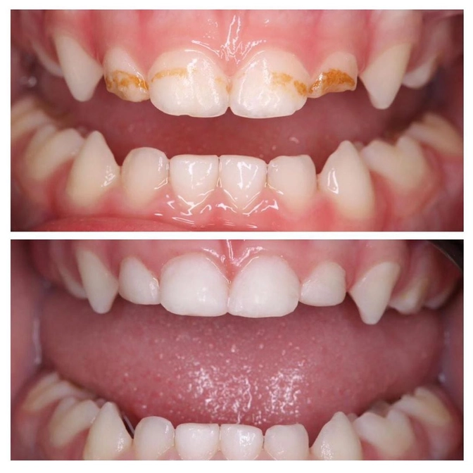 Лечение кариеса у малыша без наркоза 