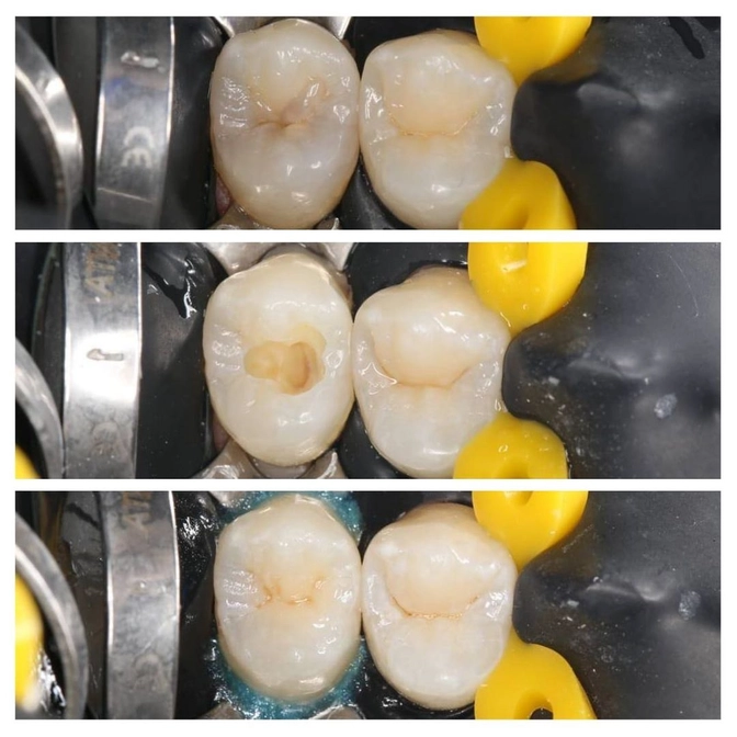 Лечение глубокого кариеса. 