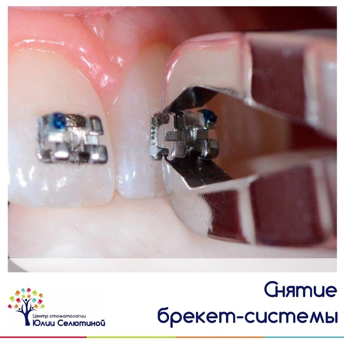 Этапы снятия брекетов