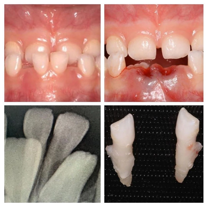 Удаление молочных зубов 