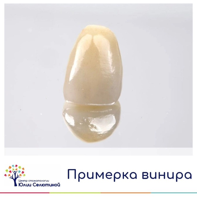 Примерка винира 