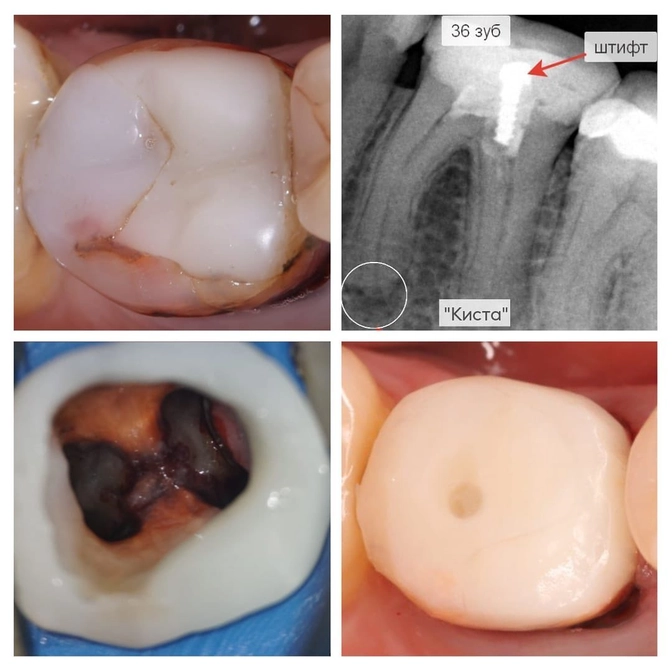 Перелечивание "красного зуба"