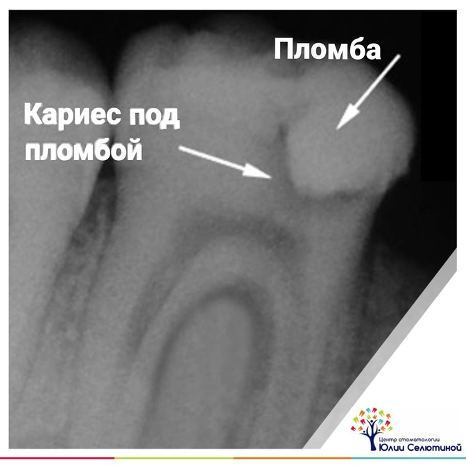 Вторичный кариес: причины, симптомы, лечение.