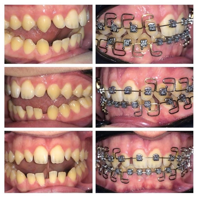 Ортодонтический случай: открытый прикус у взрослого.