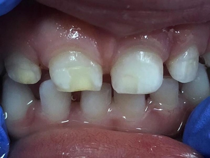 Гипоплазия эмали.