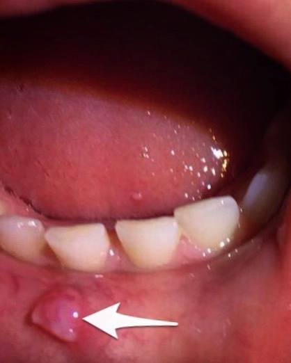 Хроническая травма.