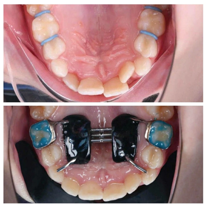 Как расширить узкую челюсть? 